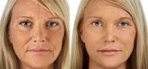 You can take any video, trim the best part, combine with other videos, add soundtrack. Acide Hyaluronique pour combler les cernes - Tout sur l ...