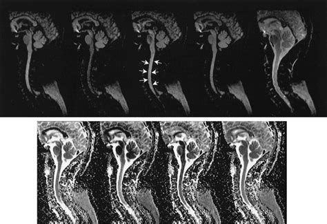 Diffusion Weighted Mr Imaging Of The Spinal Cord American Journal Of