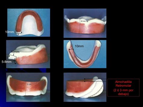 Prueba De Rodetes Y Registros En Protesis Total Laboratorio Dental