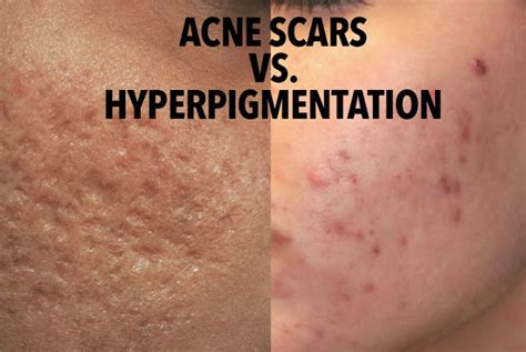 How To Get Rid Of Acne Scars According To Dermatologists Cosmetic News