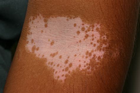 Vitiligo Causes Symptoms Vitiligo Skin Disease Treatment