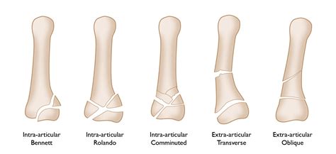 Thumb Fractures Orthoinfo Aaos