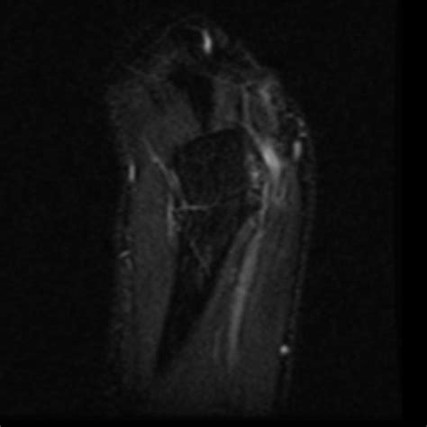 Ulnar Nerve Entrapment Syndrome In Cubitus Valgus Radiology Case