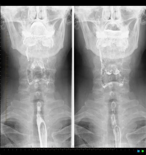 Barium Swallow Radiology Reference Article Barium