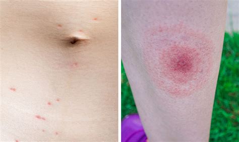 Tick Bites How To Prevent Lyme Disease Allina Health