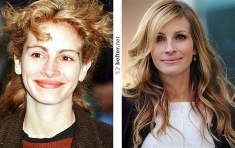 Julia Roberts Plastic Surgery Before And After Botox Injection And Nose Job Celebrity Before