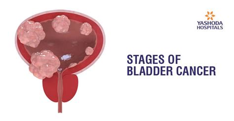 Bladder Cancer Causes Symptoms Diagnosis And Treatment