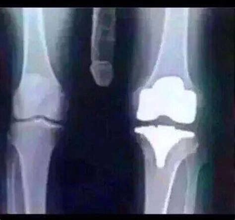 Finally Got An Xray Of My Bad Knee Not Looking Too Good For Me Imgur