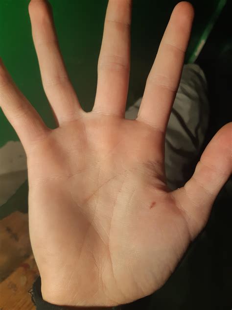 Does The Freckle On My Hand Mean Anything Palmistry