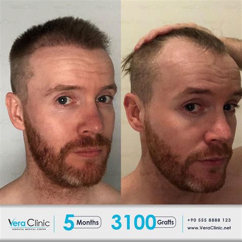 Vera Clinic Hair Transplant In Turkey En 2021 Implante