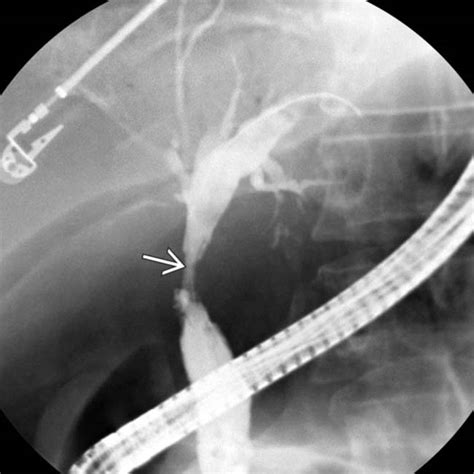 Ischemic Bile Duct Injury Clinical Gate