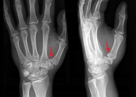 Rolando Fracture Causes Symptoms Diagnosis Treatment And Recovery