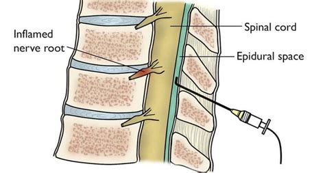 Increased Pain After Cervical Epidural Steroid Injection A Quickstart