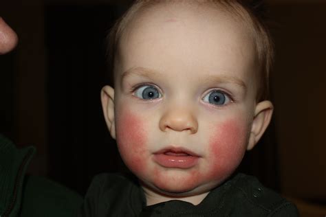 Fifth Disease Erythema Infectiosum Causes Symptoms Treatment Fifth
