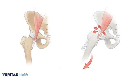 Anterior Hip Pain Snapping Hip Syndrome In Dancers Zion Physical Therapy