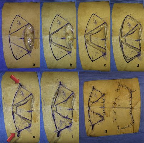 Geometrical Analysis Of The Vy Advancement Flap Applied To A Keystone