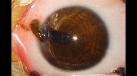 Partial Thickness Corneal Laceration