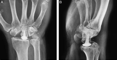 Follow Up Anteroposterior A And Lateral B Radiographs With