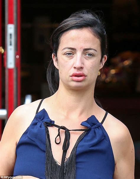 Chantelle Houghton Shows Off Painful Looking Inflated Lips Following