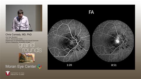 Optic Disc Edema And Choroidal Neovascular Membranes Youtube