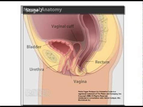 Vaginal Vault Prolapse Youtube