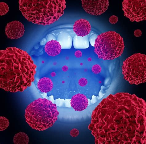 Hpv Related Oral Cancer On The Rise How To Protect Yourself