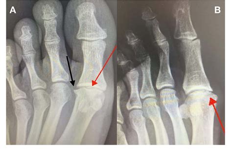 Figure 4 From A Case Report Of Osteochondritis Dissecans Of The First Metatarsophalangeal Joint