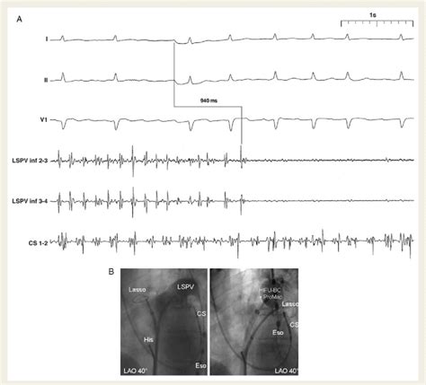 A Rapid Pulmonary Vein Isolation Shown Are Surface Ecg Leads I Ii