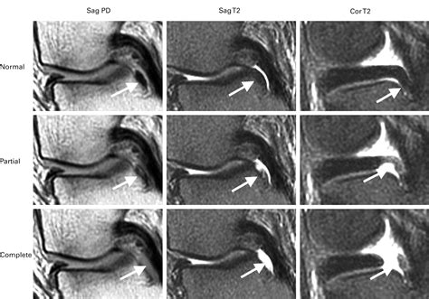 Meniscal Root Injury And Spontaneous Osteonecrosis Of The Knee Bone Joint