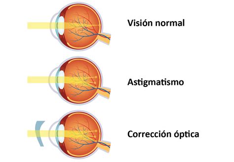 Astigmatismo En Ni Os Cl Nica En Cantabria Fern Ndez Casas