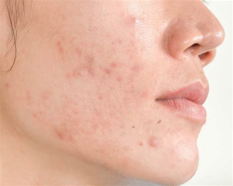 What Complications You Can Have Due To Acne In 2021 Back Acne