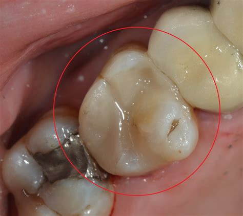 A BLOG ABOUT LIFE AND DENTISTRY: Cracked Amalgam Fillings