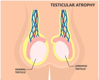 Testicular Atrophy And Its Ayurvedic Treatment With Herbs