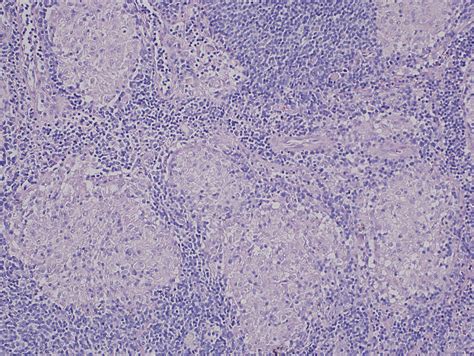 Mediastinoscopic Lymph Node Biopsy Releaving Non Caseating Download Scientific Diagram