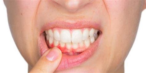 Entz Ndung Des Zahnfleisches Erkennen Und Behandeln