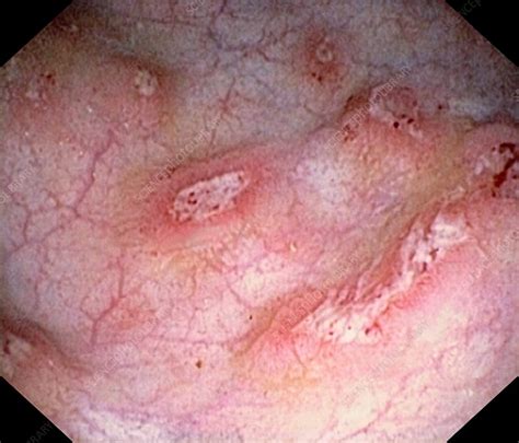 Crohn S Disease Stock Image C Science Photo Library