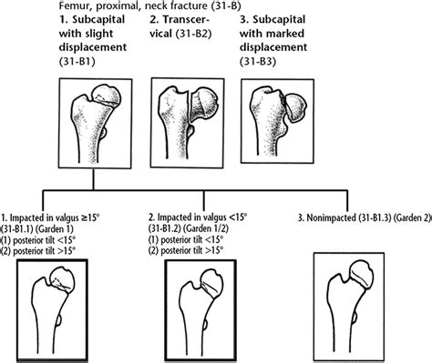 Otaao Classification Of Femoral Neck Fractures Download Scientific