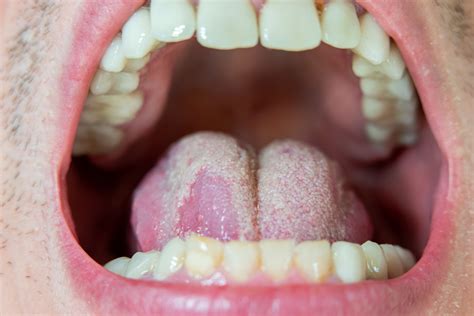 4 Tipos De Infecciones Que Puedes Contraer En La Boca Por Un Oral Sin