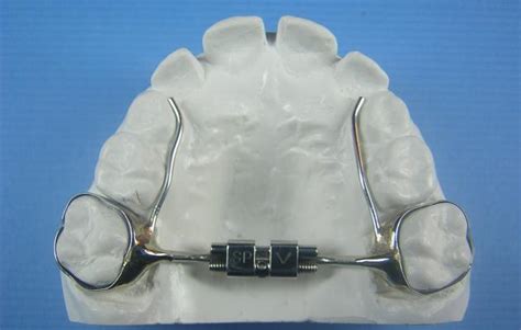 Mini Screw Expander Accutech Orthodontic Labs