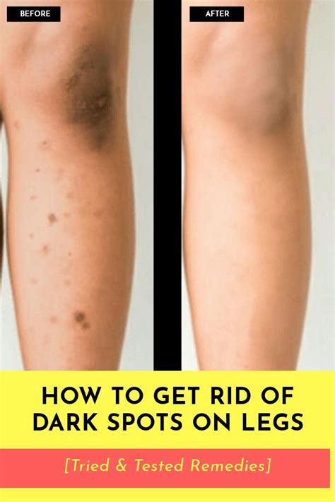 How To Remove Dark Spots On Legs Dark Spots On Legs Dark Spots On