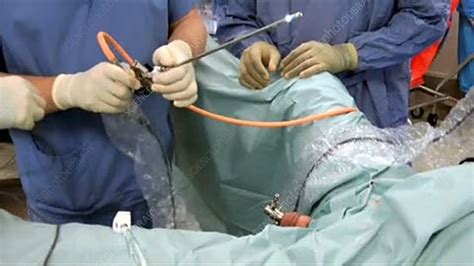 Bladder Cancer Surgery Stock Video Clip K0029572 Science Photo