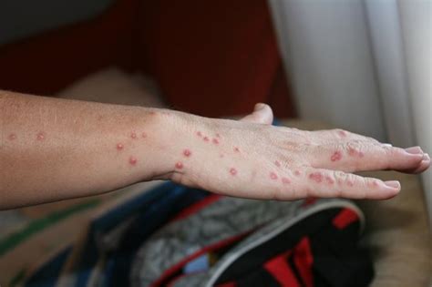 My Hand With Bed Bug Bites Picture Of Gran Hotel Del Sella
