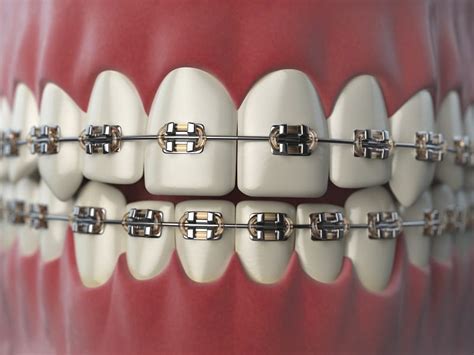 Dental Braces Their Types And Costs