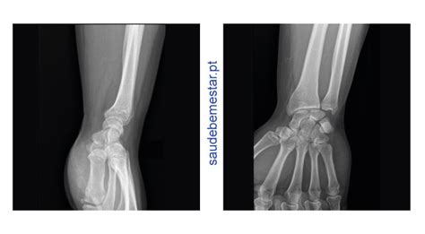 Radiografia Ou Raio X Rx Do Punho Ou Pulso Exames Rx