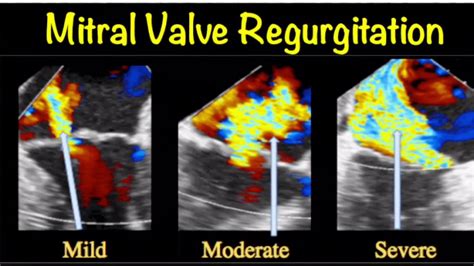 Mitral Valve Prolapse Repair Youtube