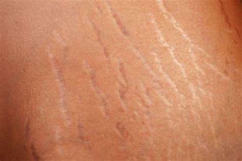 What Are Stretch Marks What Causes It And How To Prevent It