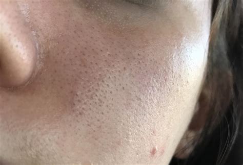 Orange Peel Skin Disaster W Pictures General Acne Discussion By