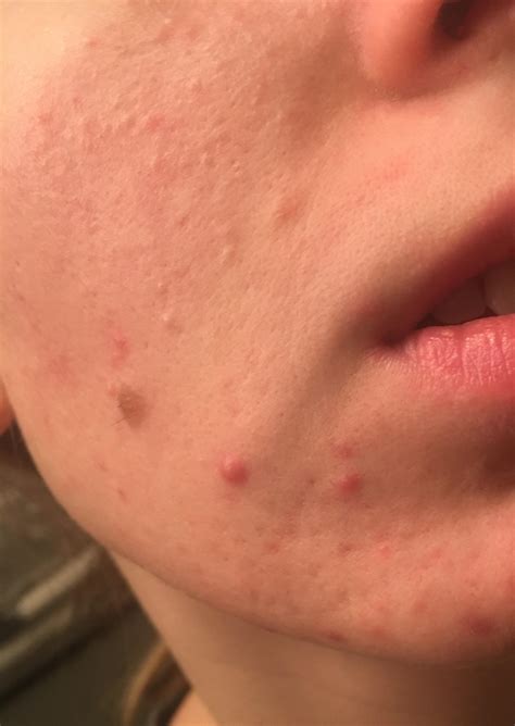 Acne Please Help My Pores Are So Clogged And Ive Tried Everything