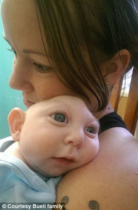 Bebê Que Nasceu Sem Parte Do Cérebro E Crânio Vem Surpreendendo Médicos