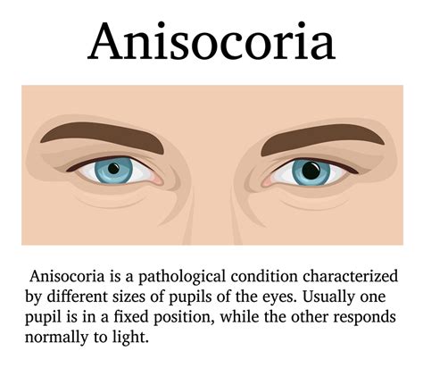 Anisocoria Eye Patient
